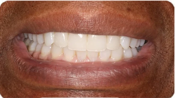 After orthodontic treatment