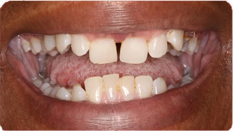Before orthodontic treatment