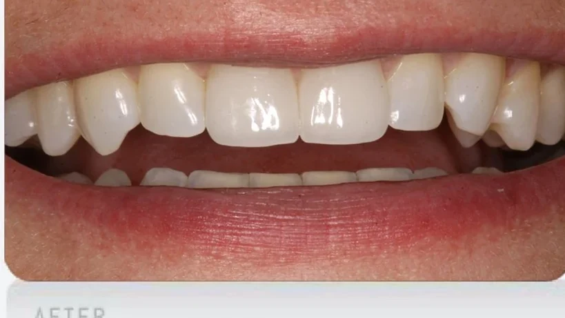 After chipped teeth