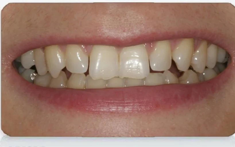 Before chipped teeth