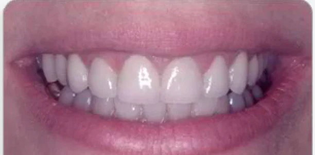 After a gummy smile