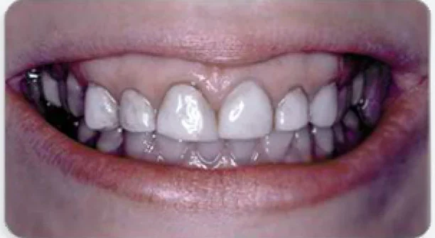 Before a gummy smile