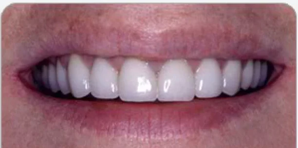 After misaligned teeth