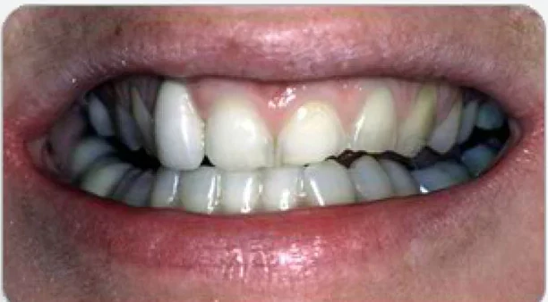 Before misaligned teeth