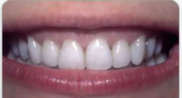 After spaced teeth