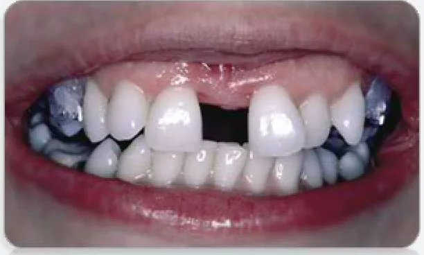 Before spaced teeth