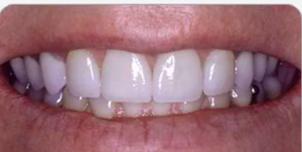 After stained teeth