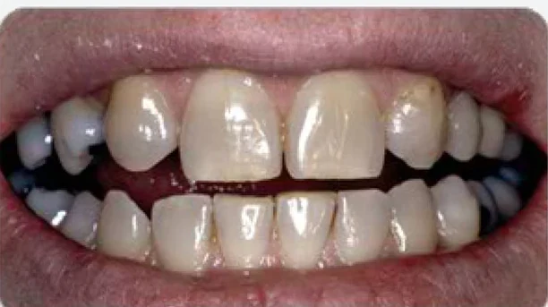 Before stained teeth