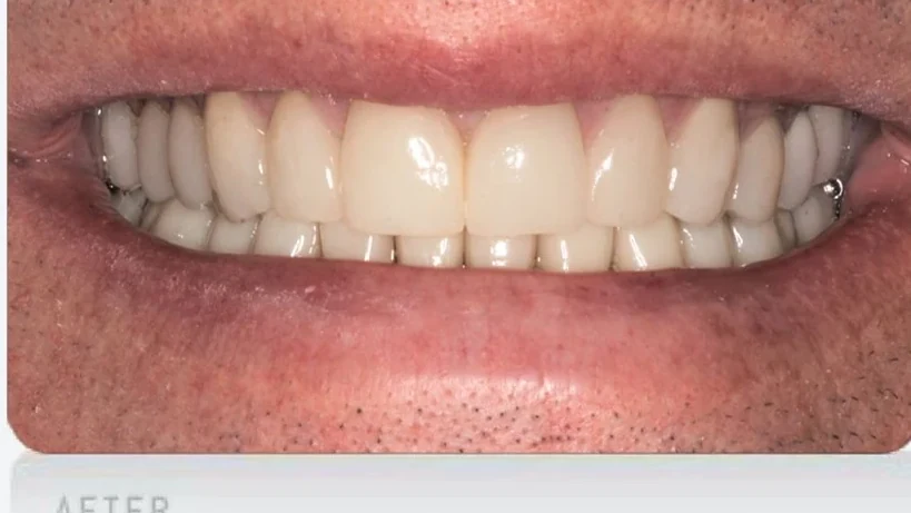 After worn teeth