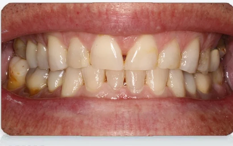 Before worn teeth