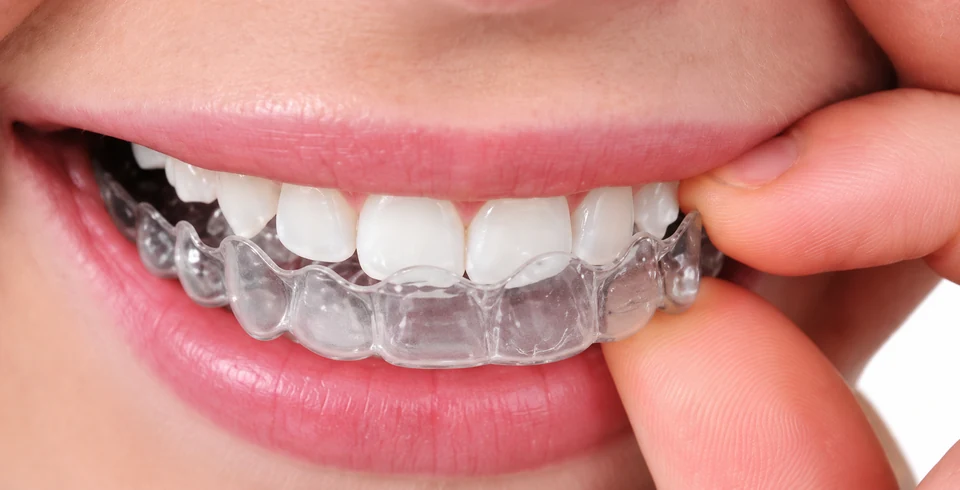 Clear aligner being fitted over teeth