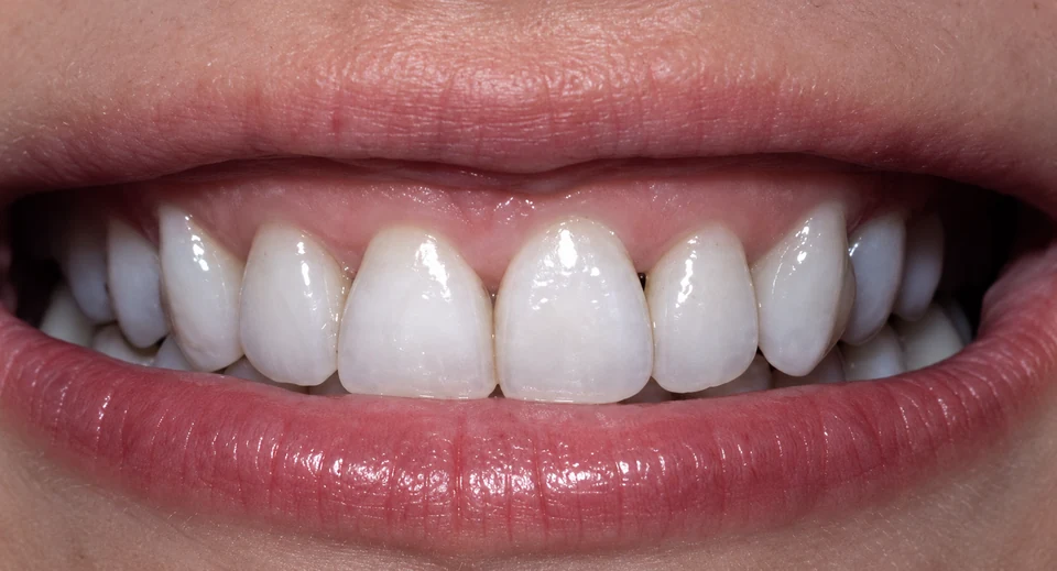 After spaced teeth