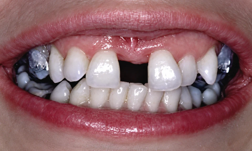 Before spaced teeth