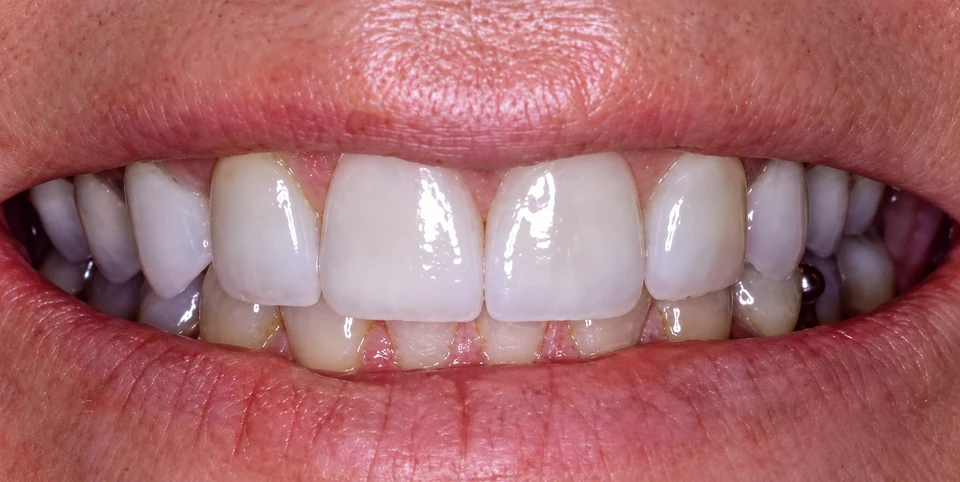 After stained teeth