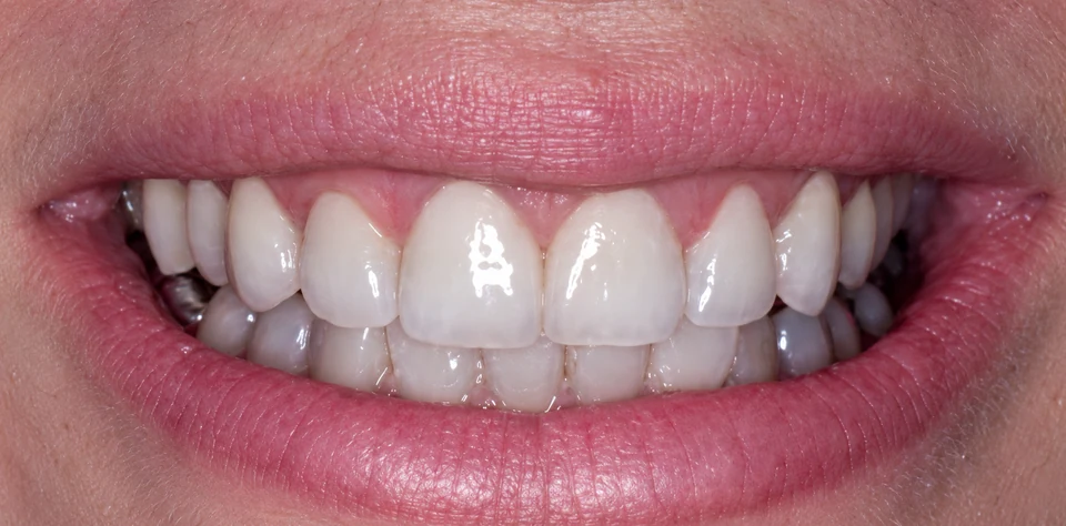 After a gummy smile