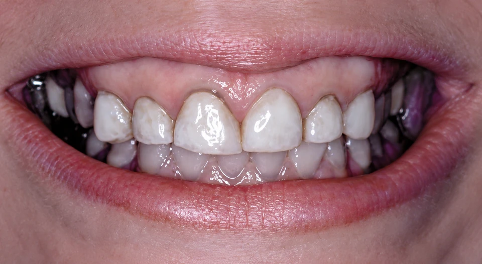 Before a gummy smile