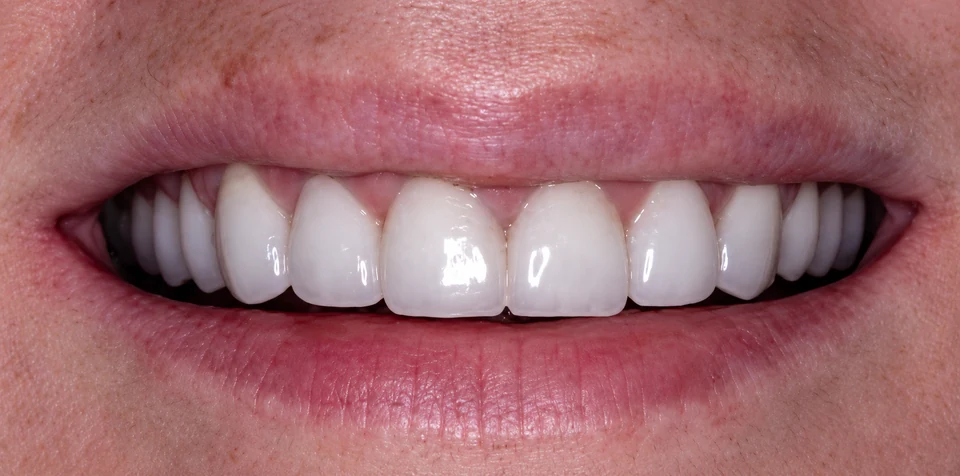 After misaligned teeth
