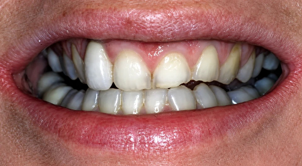 Before misaligned teeth