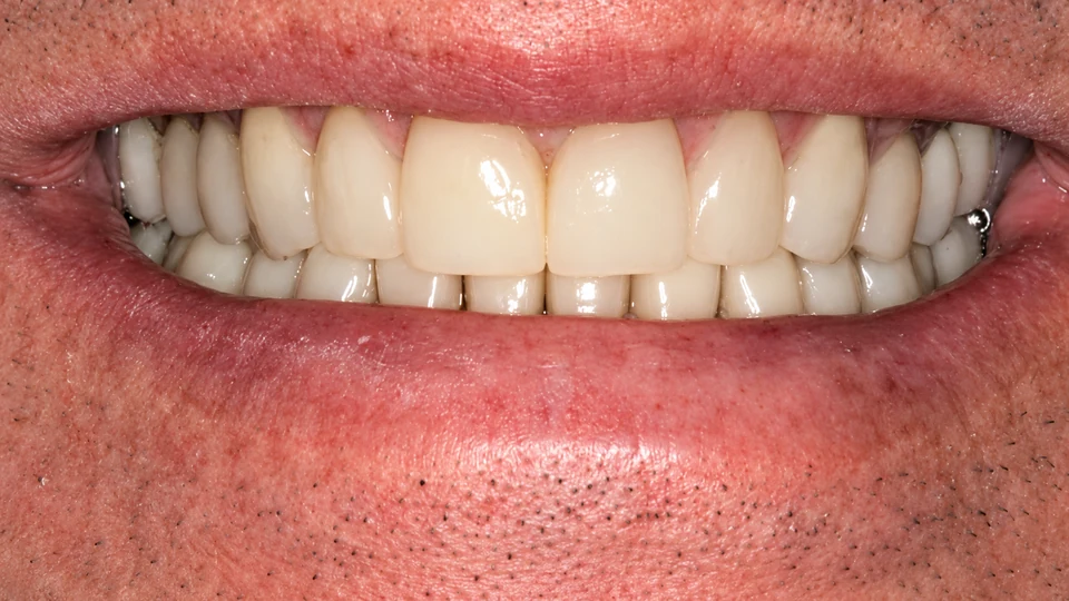 After worn teeth