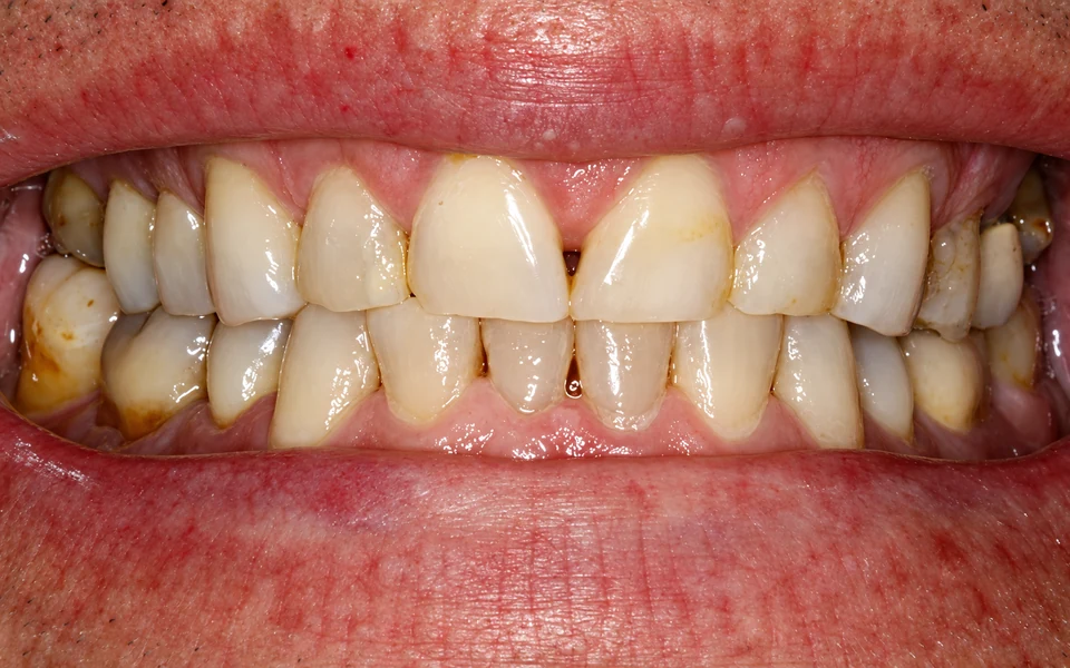 Before worn teeth