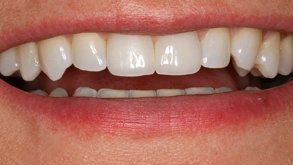 After chipped teeth