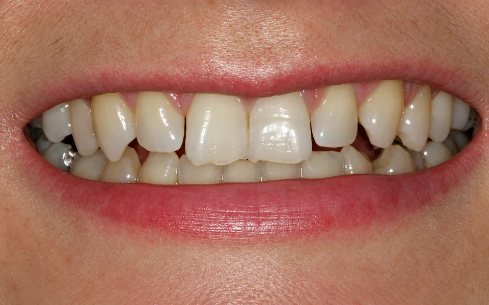 Before chipped teeth