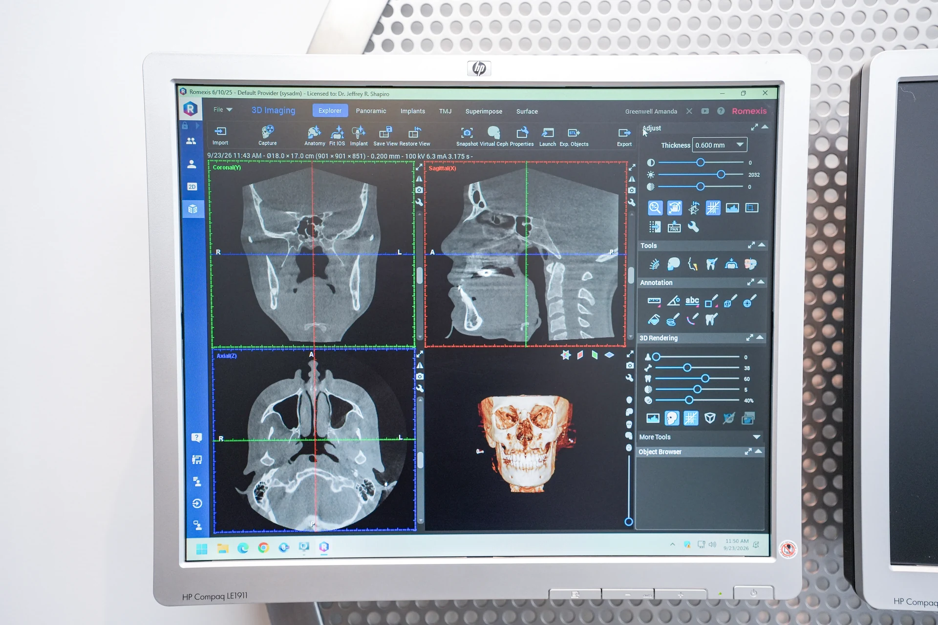 Digital dental scan on a monitor