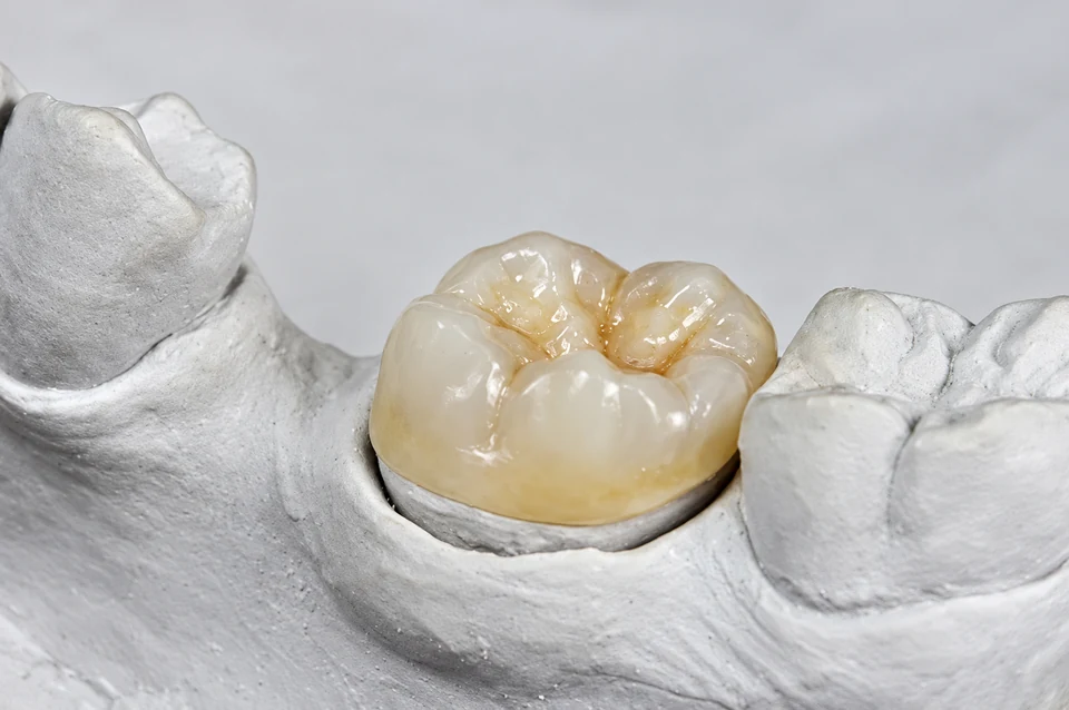 Porcelain onlay