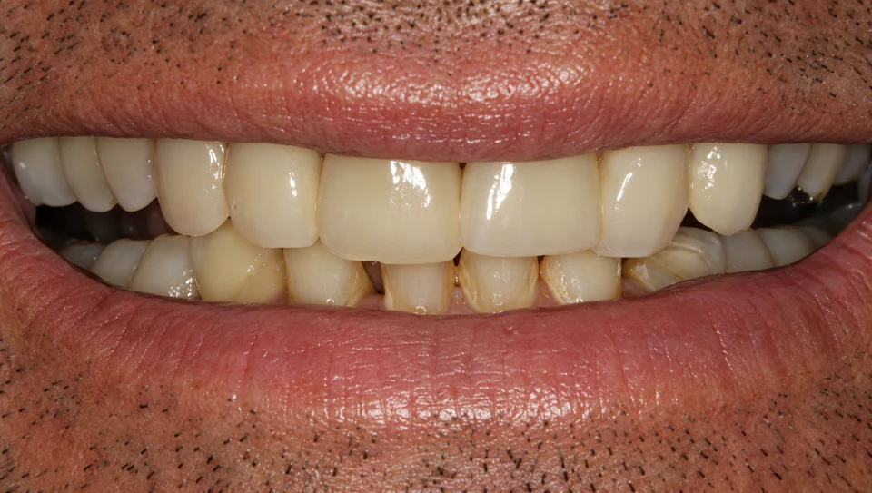 Before porcelain veneers
