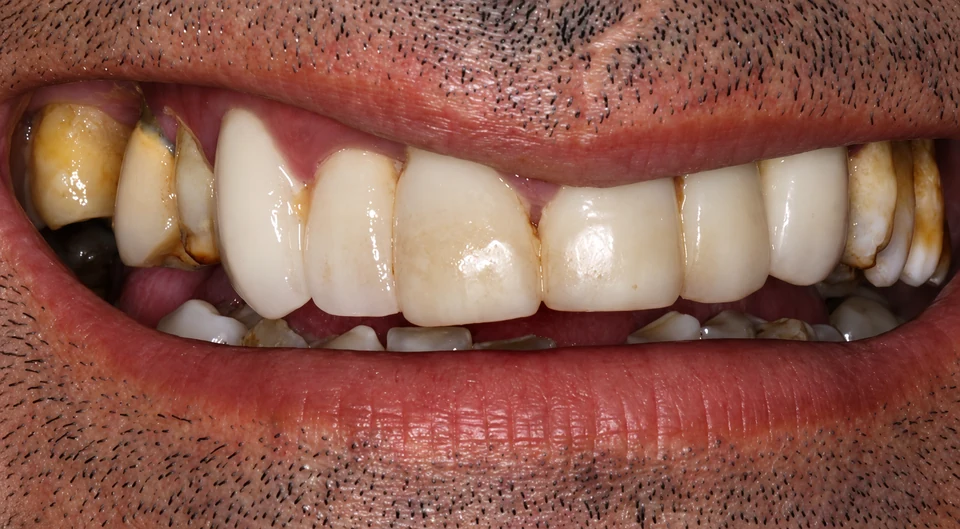 Before Dental implants