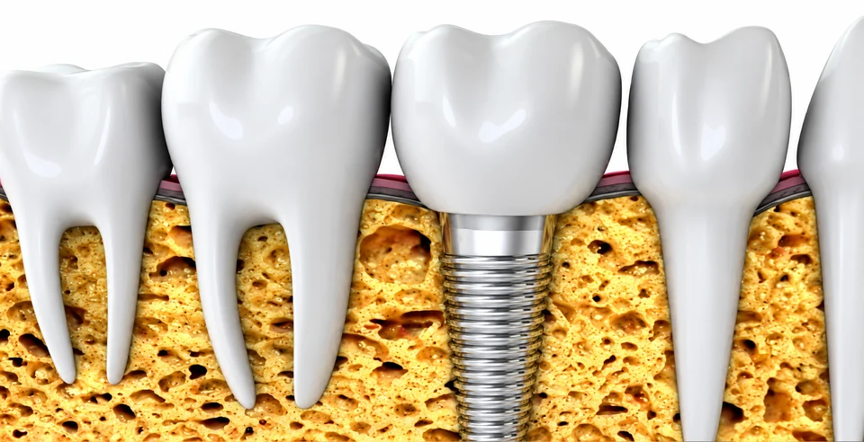 Dental implant illustration