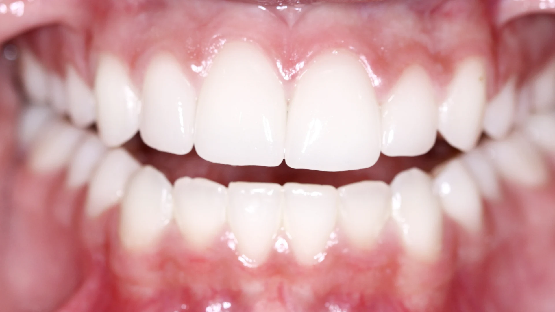 Restored smile after dental treatment