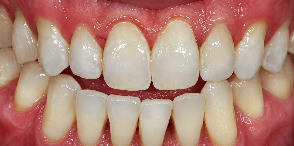 After Microabrasion case 2