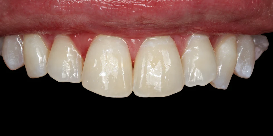 After Microabrasion case 3