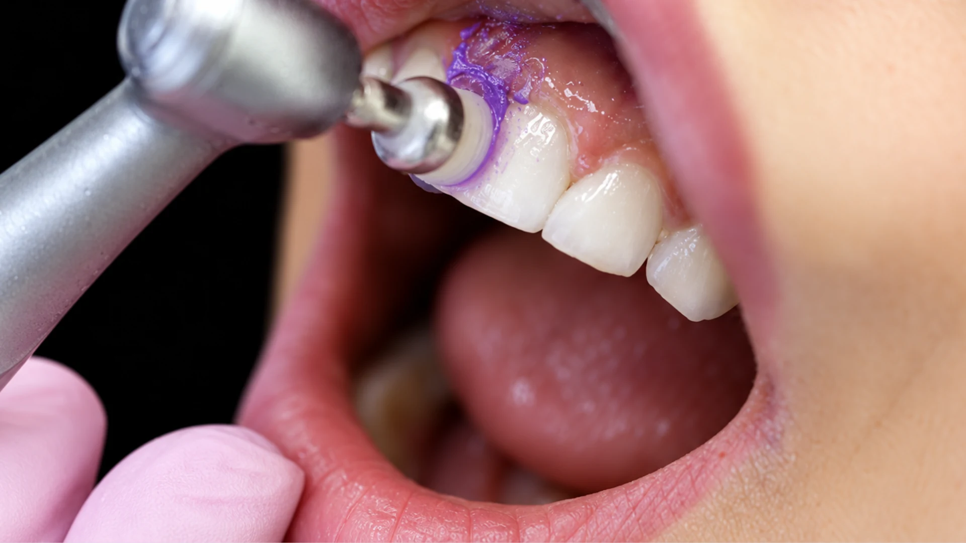 Dental microabrasion treatment
