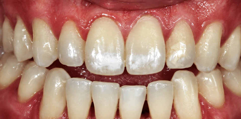 Before Microabrasion case 2