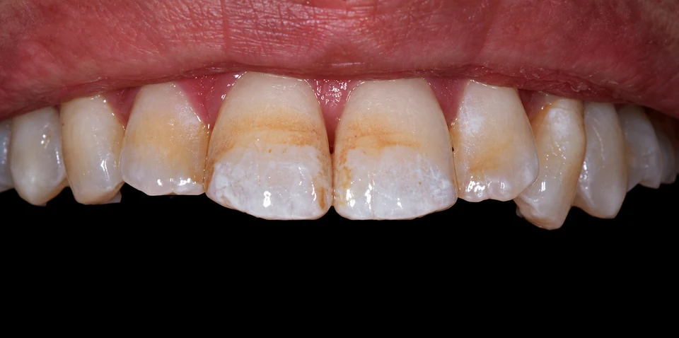 Before Microabrasion case 3