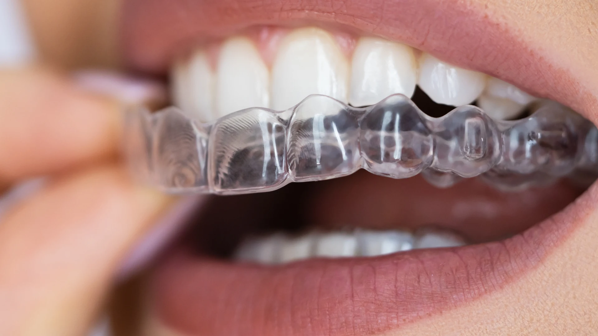 Clear orthodontic aligner
