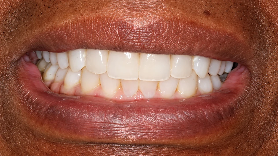 Before orthodontic treatment