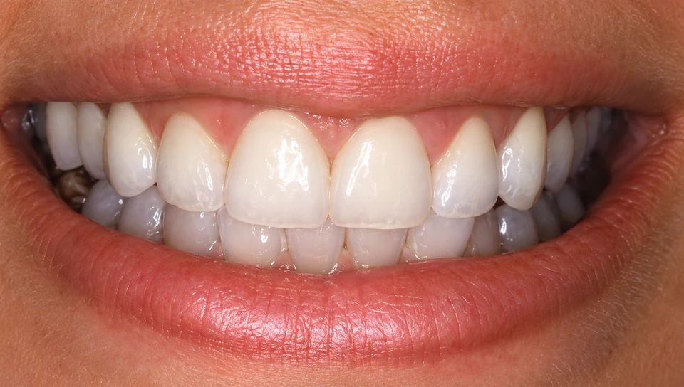 After Periodontal plastic surgery
