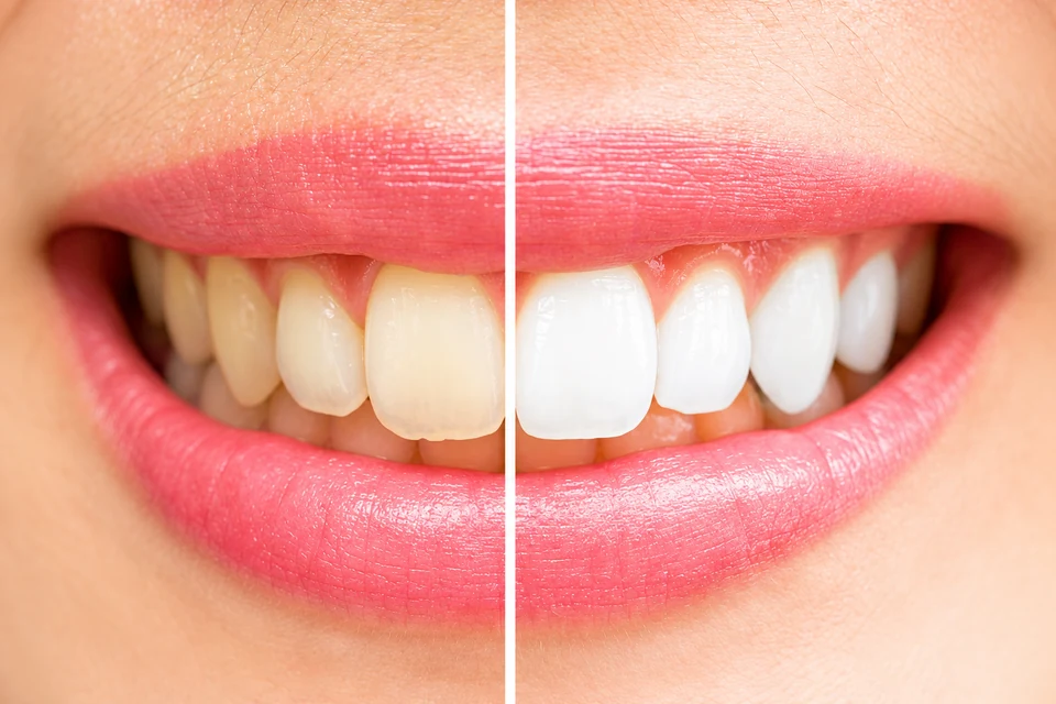 Teeth whitening result