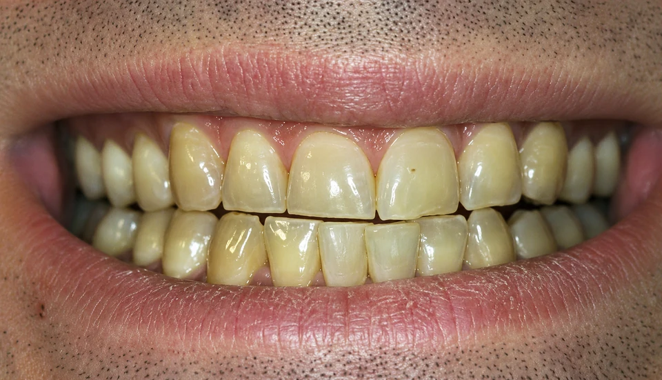 Before Teeth whitening