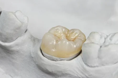 Porcelain onlay