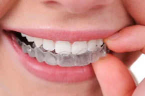 Clear Invisalign aligner