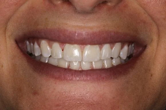 Smile after microabrasion