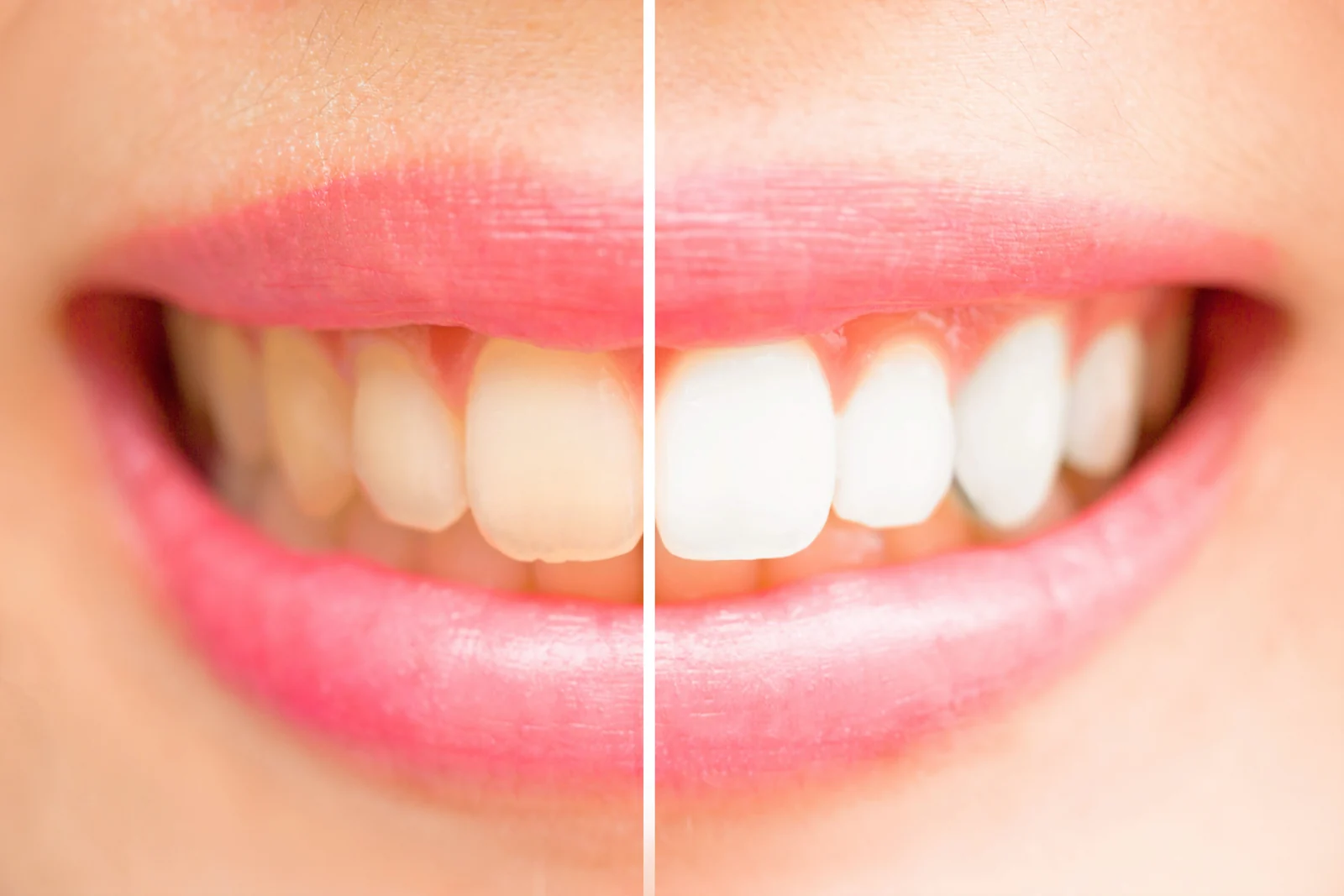 Teeth whitening result