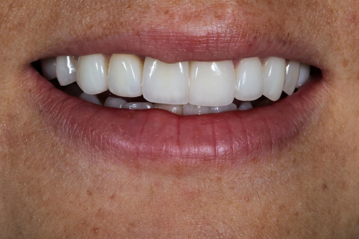 Case 1 after treatment
