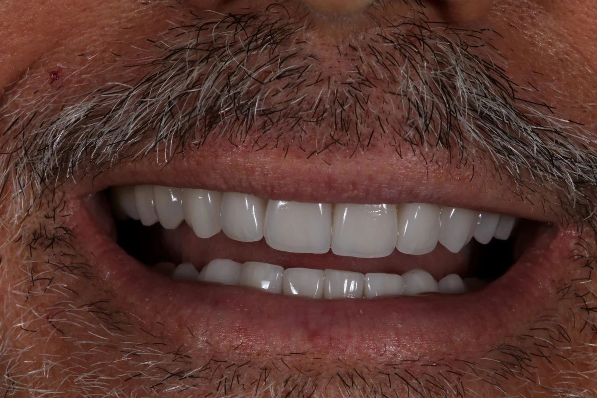 Case 3 after treatment