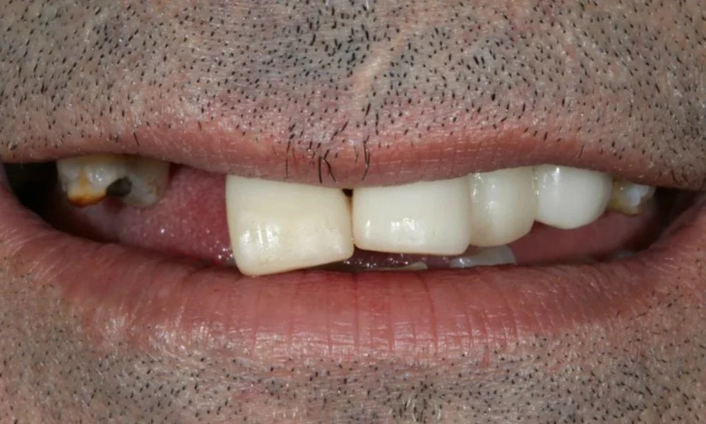 Case 4 before treatment