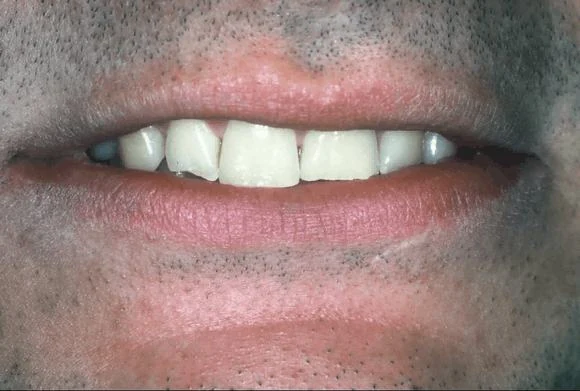 Case 5 before treatment